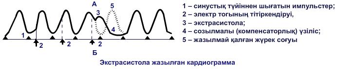 Экстрасистола жазылған кардиограмма